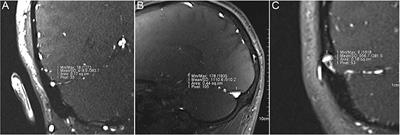 Intracranial pressure, lateral sinus patency, and jugular ultrasound hemodynamics in patients with venous pulsatile tinnitus